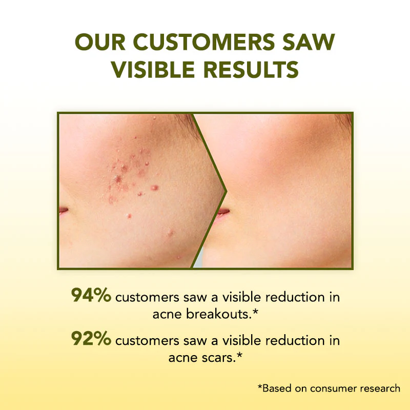 Anti Acne Face Wash - 100ml - Image 6